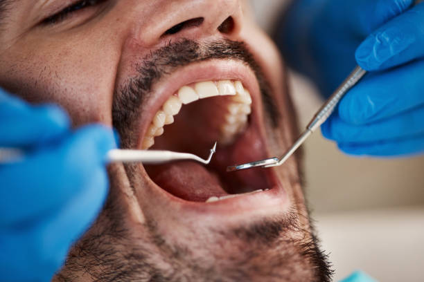Best Emergency Dentist for Lost Fillings or Crowns in Tremont, PA